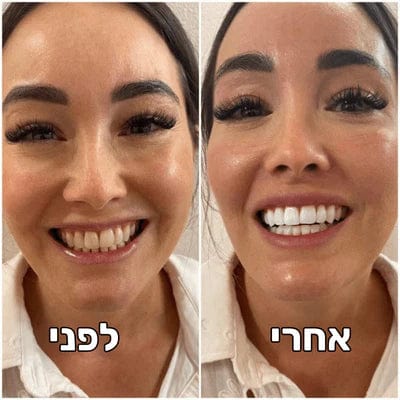 משחה להלבנת השיניים